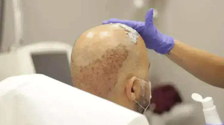 Washing Hair After Hair Transplantation