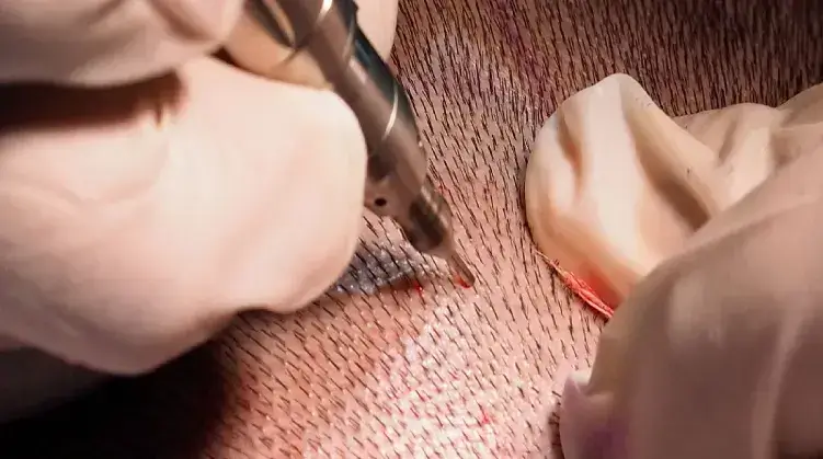 Manual Fue Hair Transplantation