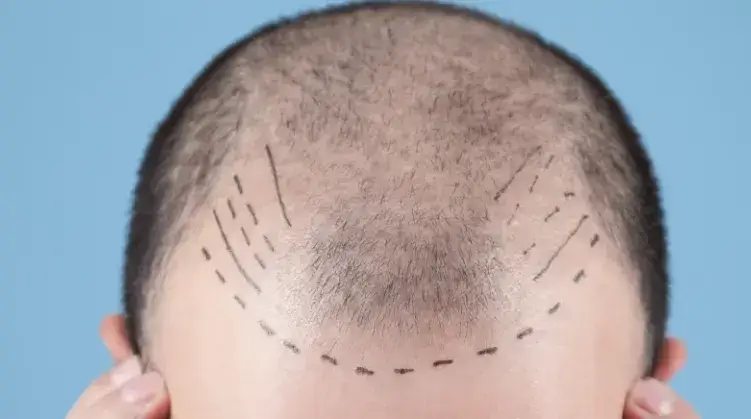 Hair Transplant Operation
