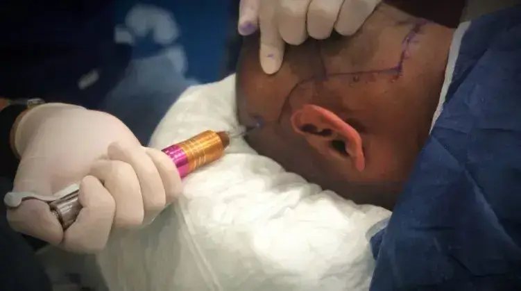 Needle-Free Anesthesia