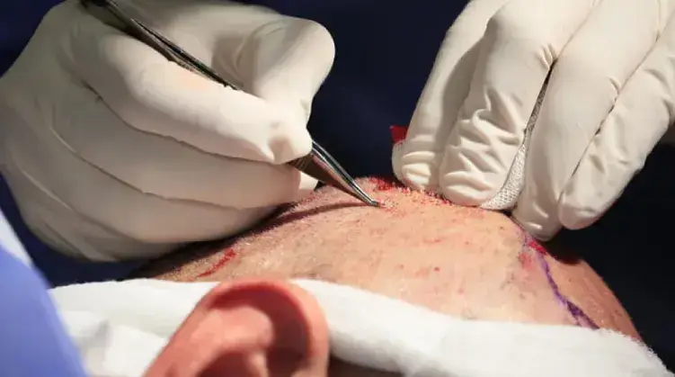 What is Graft in Hair Transplantation?